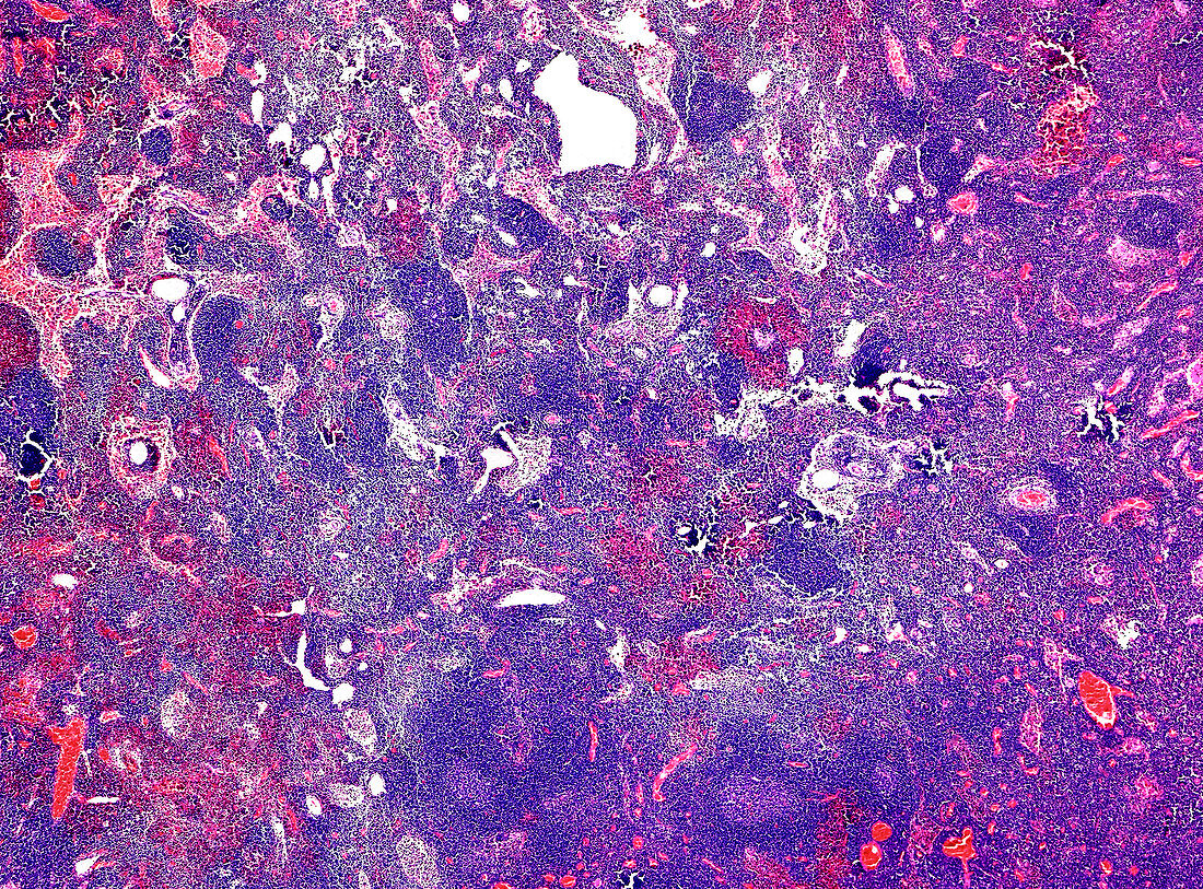 Necrotising lymphadenitis, light micrograph