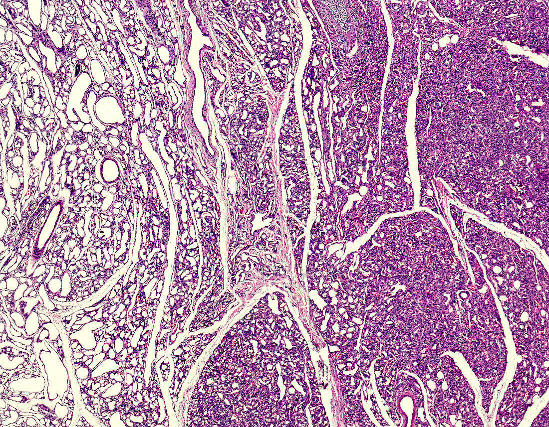 Capillary haemangioma, light micrograph
