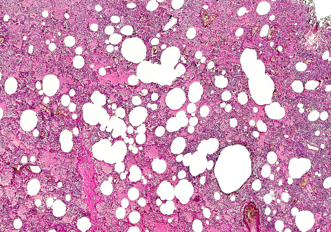 Lobar pneumonia haemorrhagic oedema, light micrograph