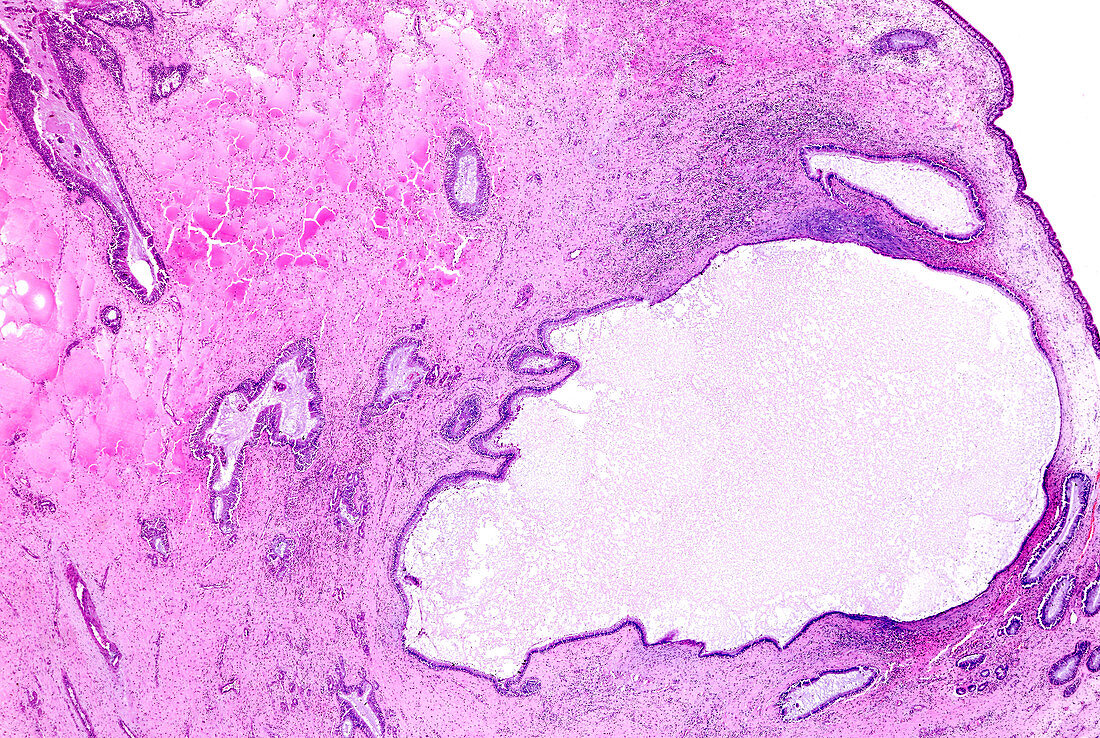Inflammatory polyp, light micrograph