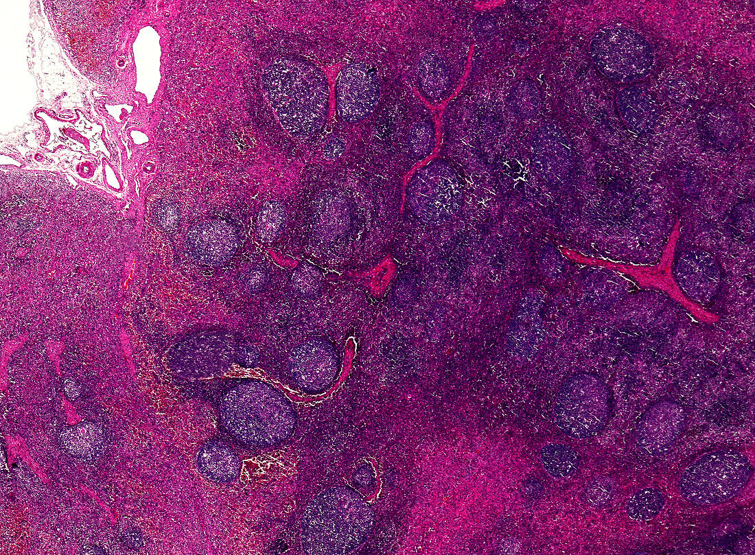 Haemorrhagic lymph nodes, light micrograph