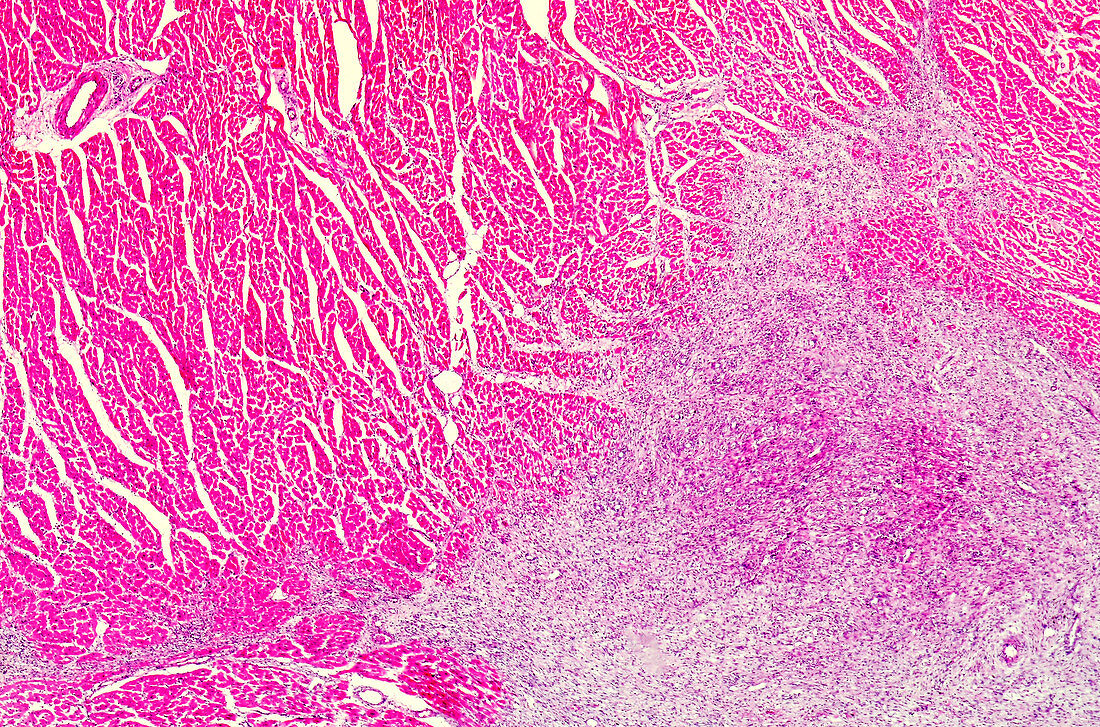Bacterial myocarditis, light micrograph