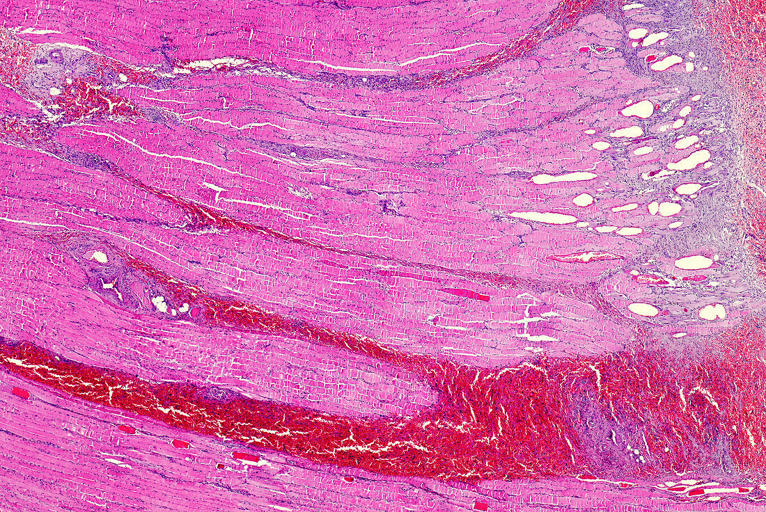 Skeletal muscle atrophy, light micrograph