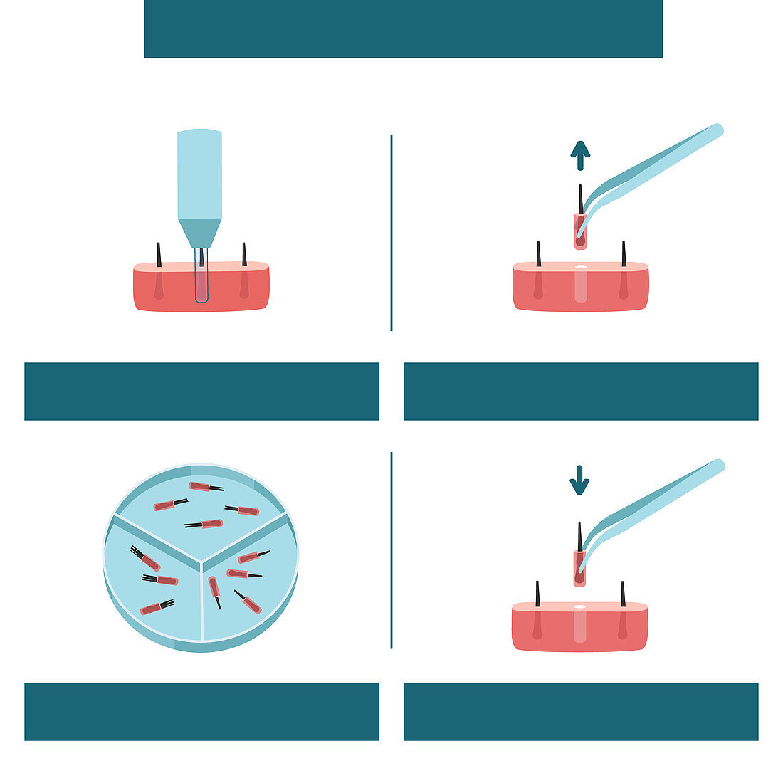 FUE hair transplantation, illustration