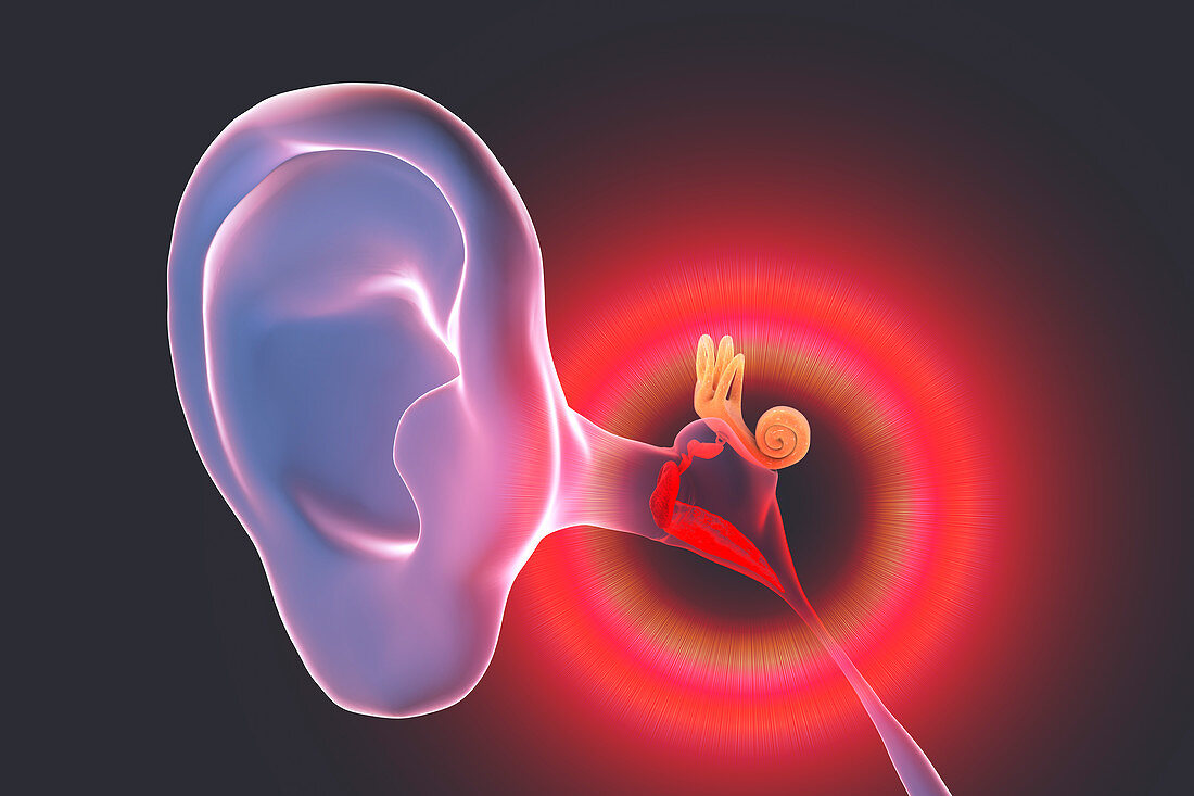 Otitis media ear infection, illustration