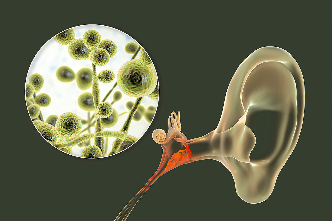 Chronic fungal otitis media ear infection, illustration