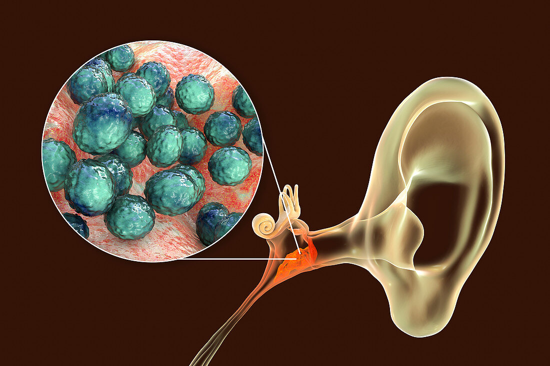 Otitis media ear infection, illustration