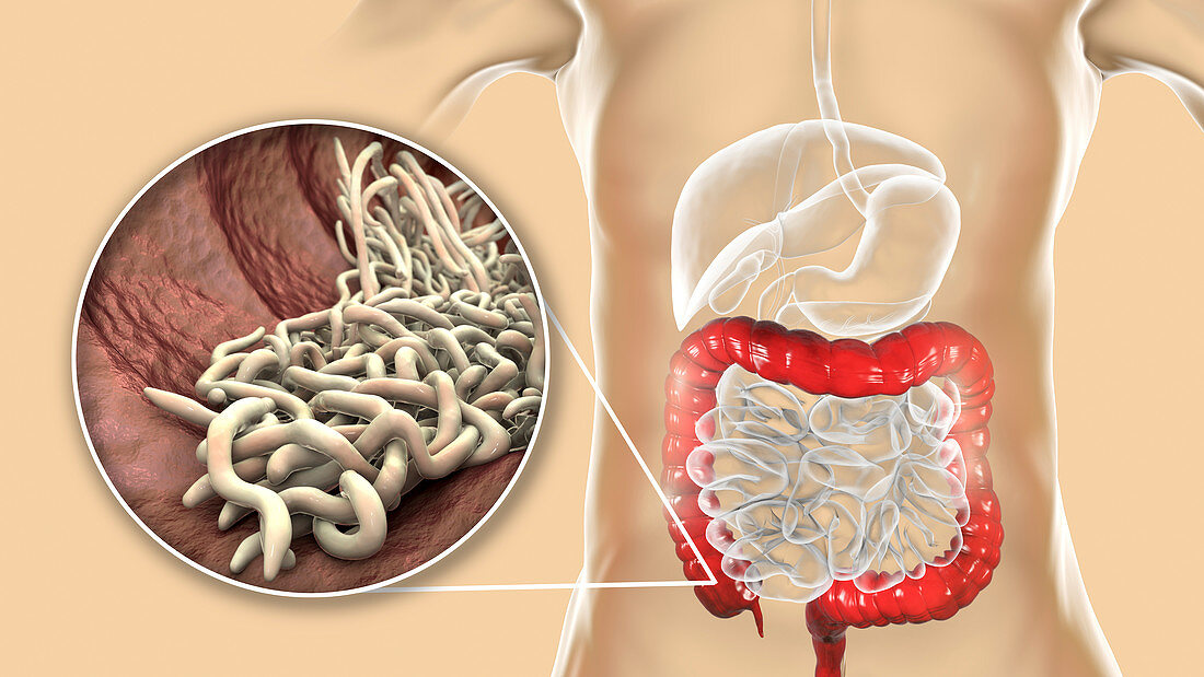 Round worms in human large intestine, illustration