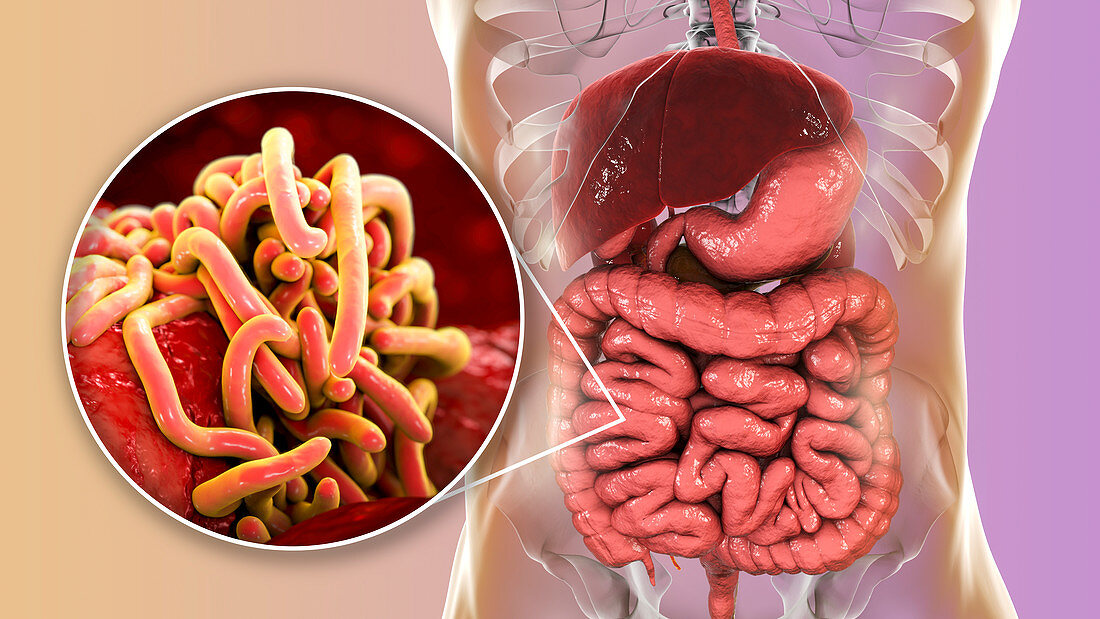 Round worms in human intestine, illustration