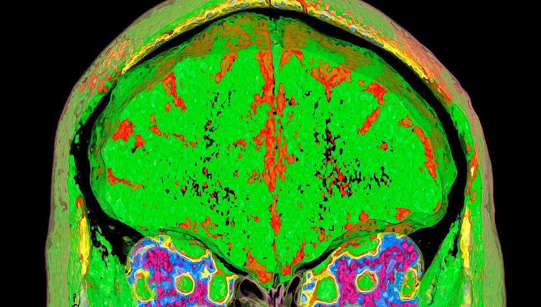 Human head and brain, CT scan
