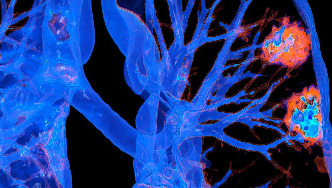 Lungs affected by Covid-19 pneumonia, CT scan