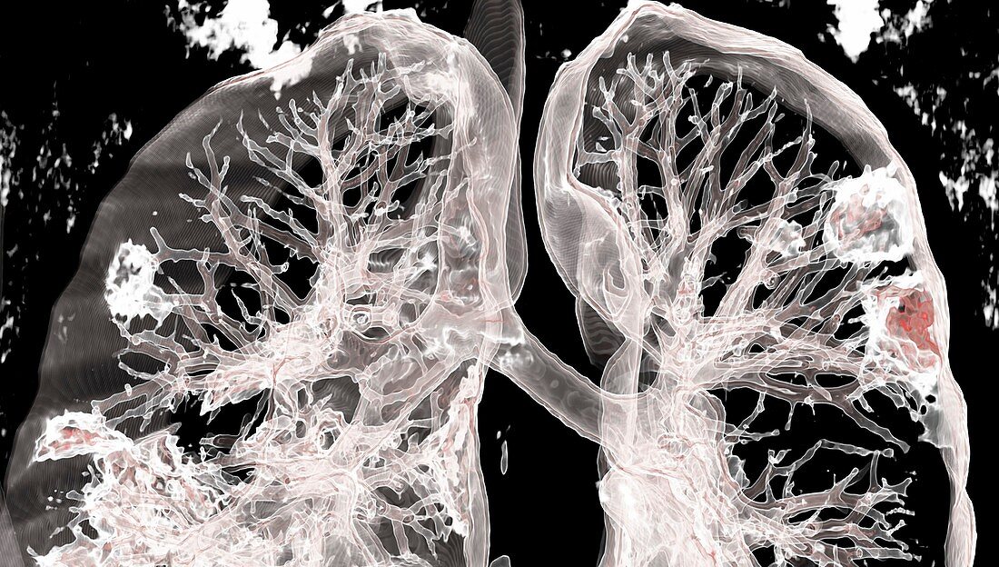 Lungs affected by Covid-19 pneumonia, CT scan