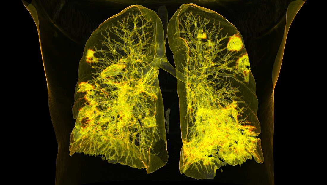 Lungs affected by Covid-19 pneumonia, CT scan