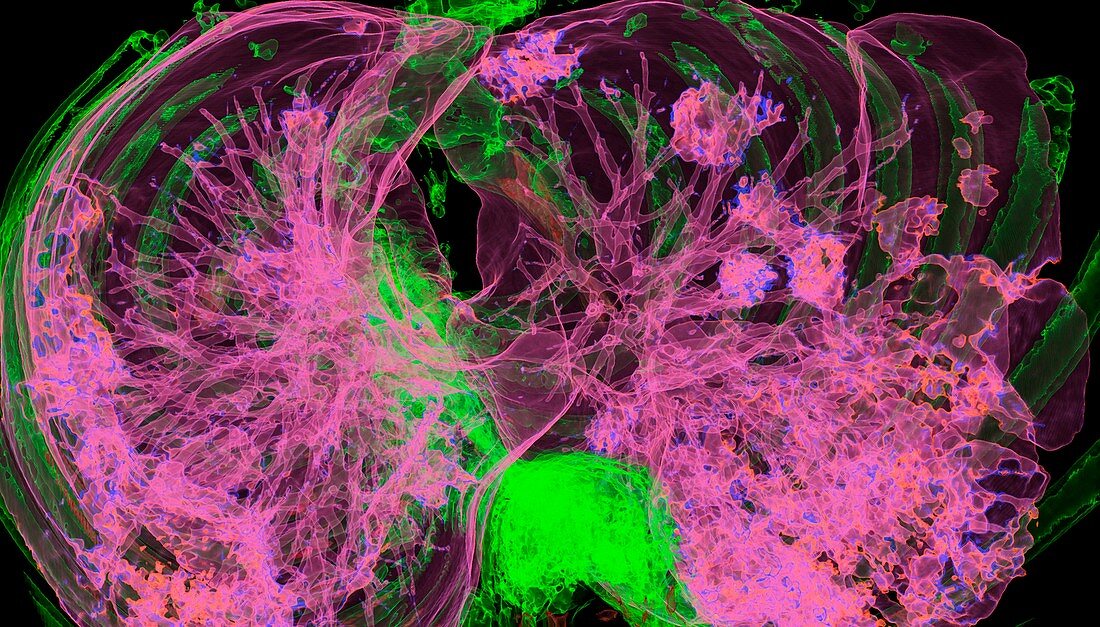 Lungs affected by Covid-19 pneumonia, CT scan