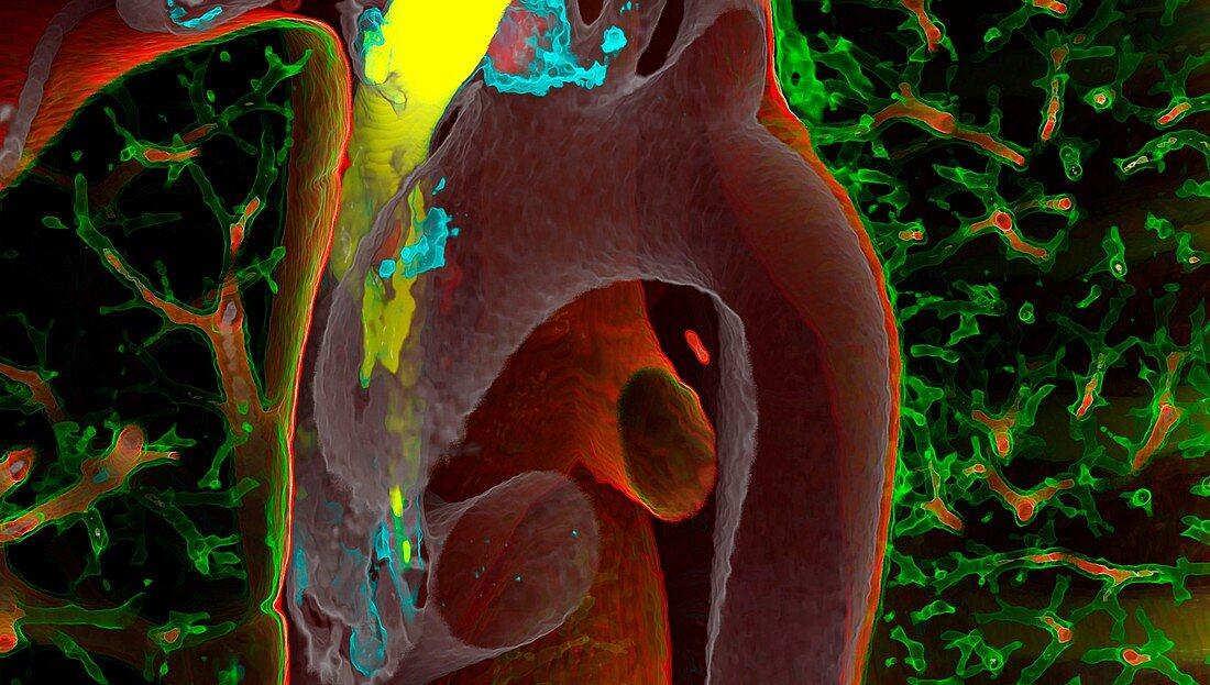 Heart, aorta and lungs, CT scan