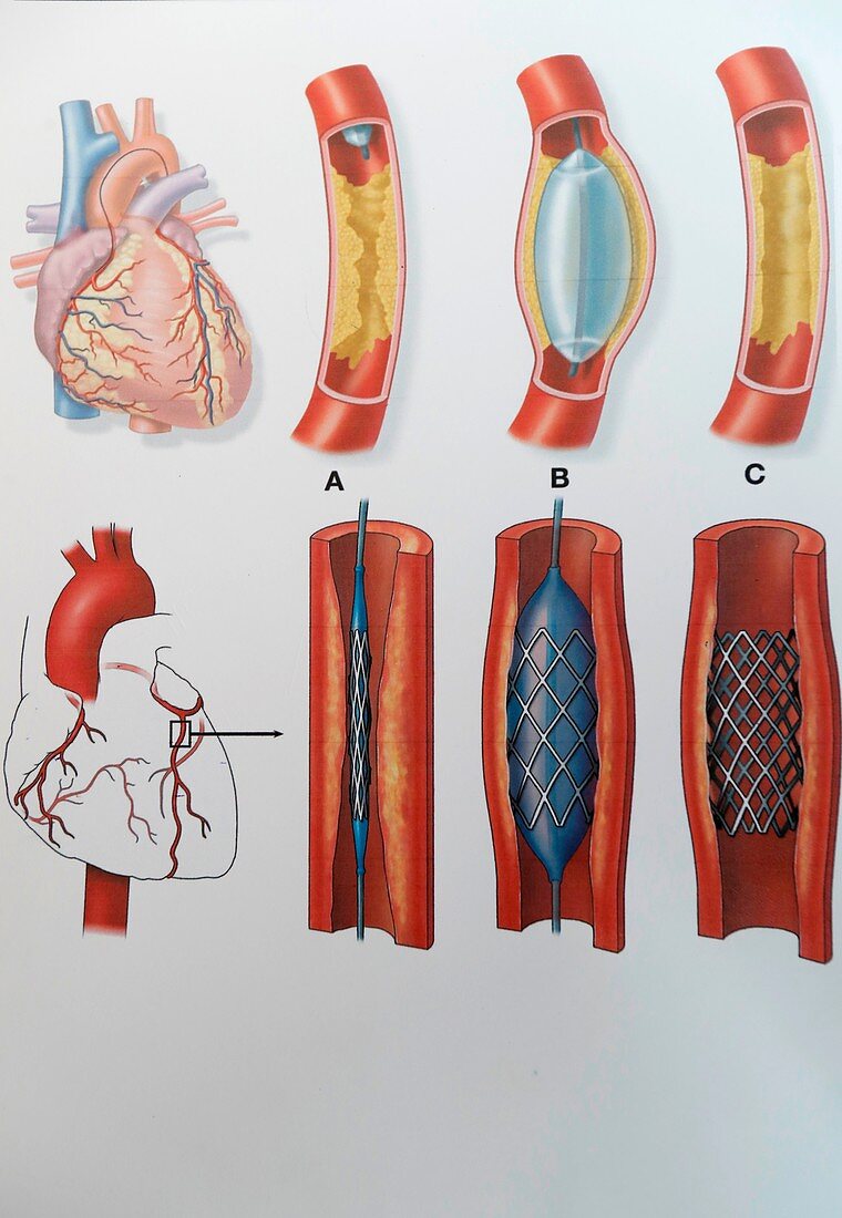 Aortic stenosis