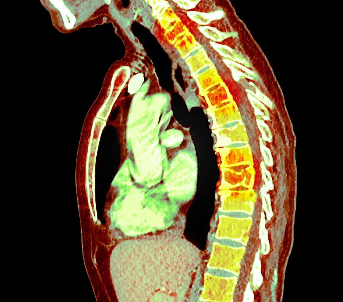 Multiple myeloma of the spine, CT MRI scan