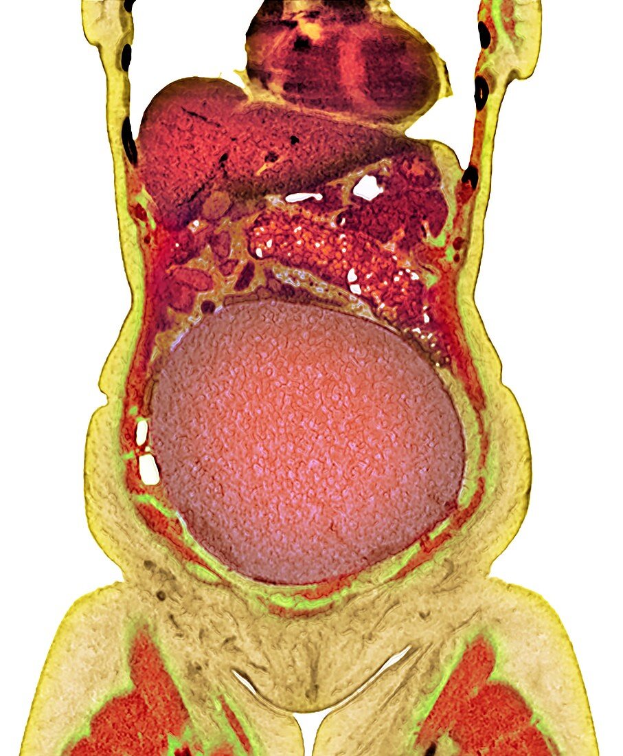 Ovarian cancer, CT scan