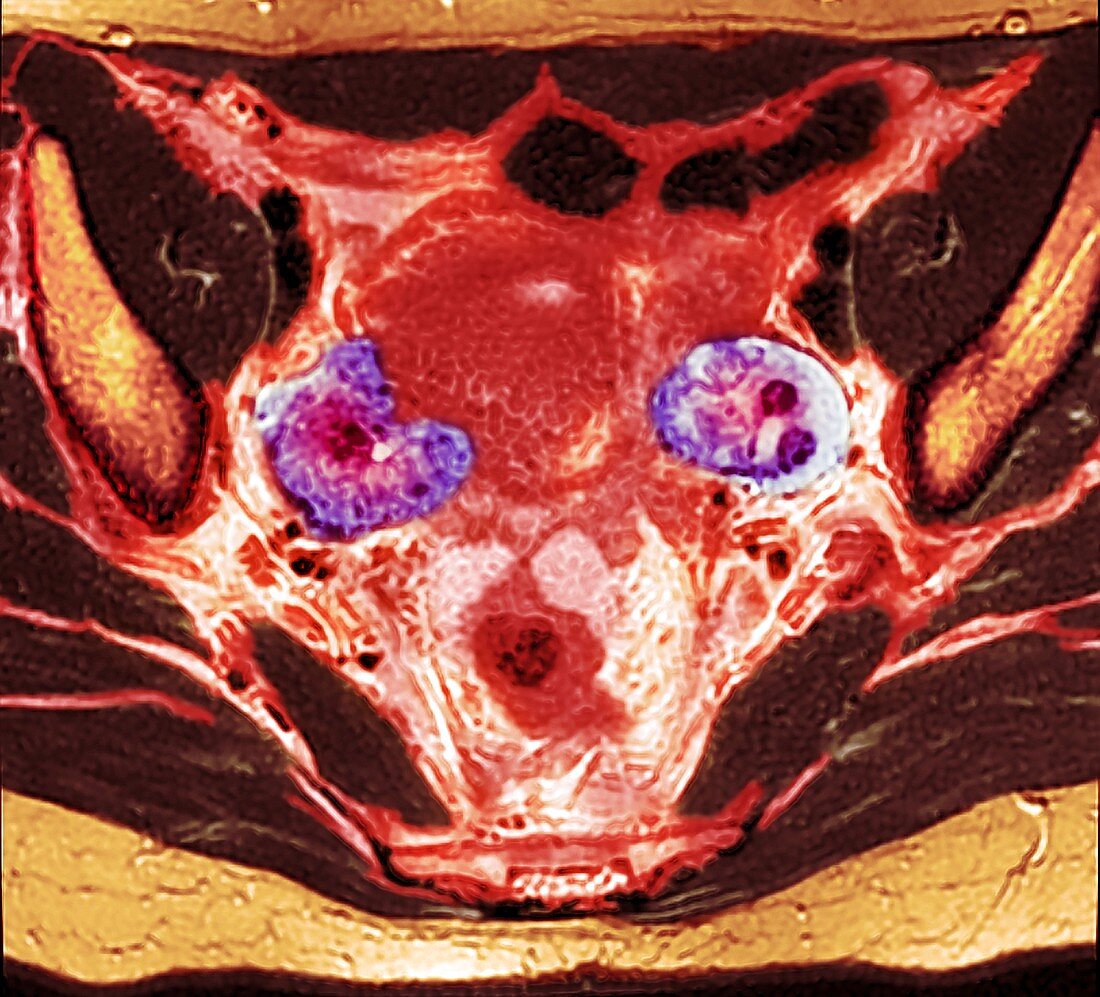 Ovarian cancer, MRI scan