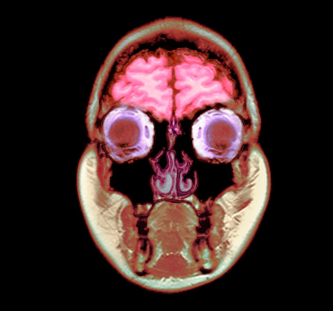 Human head, MRI scan