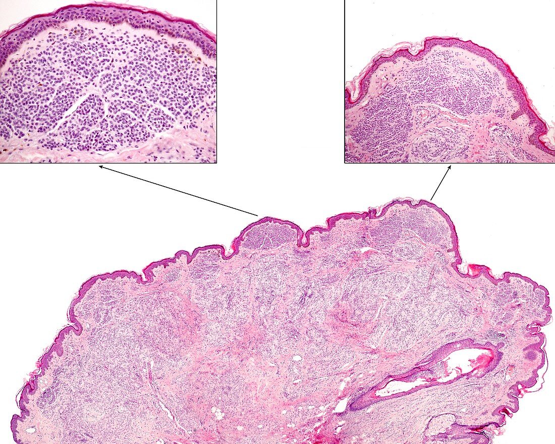 Intradermal nevus, light micrograph