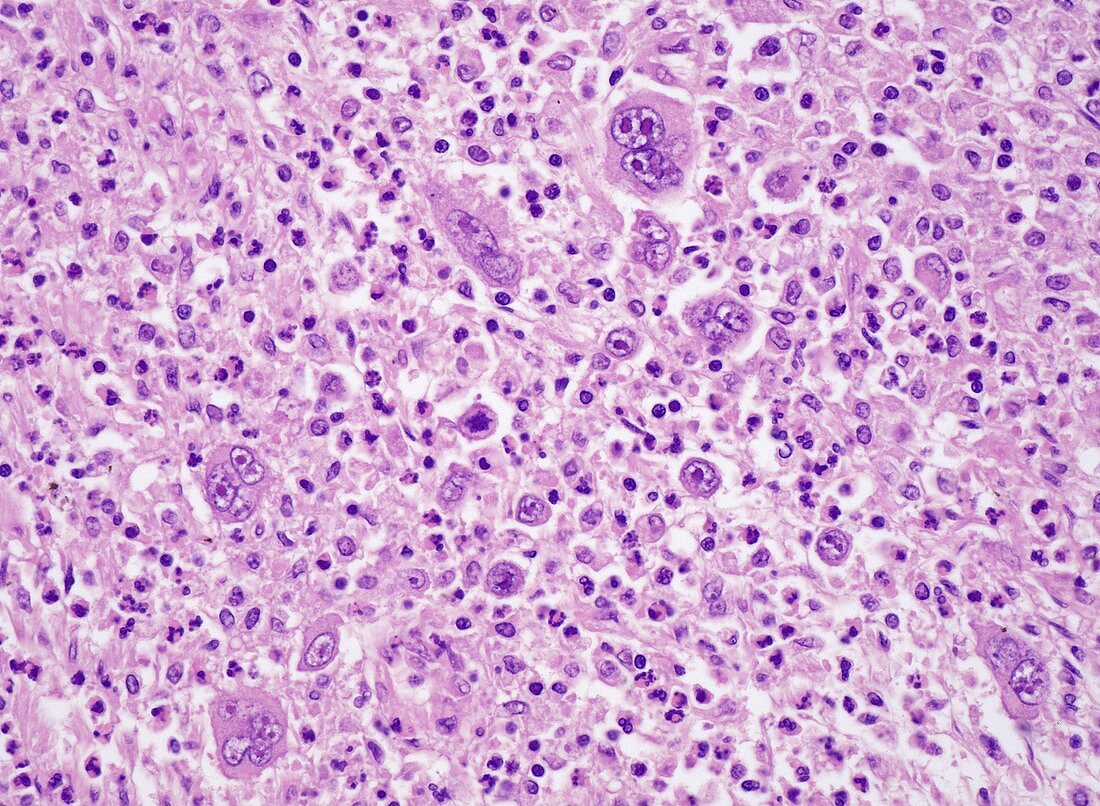 Mixed cellularity Hodgkin lymphoma, light micrograph