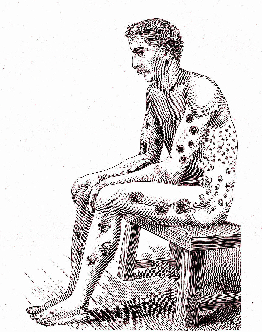 19th Century syphilis patient, illustration