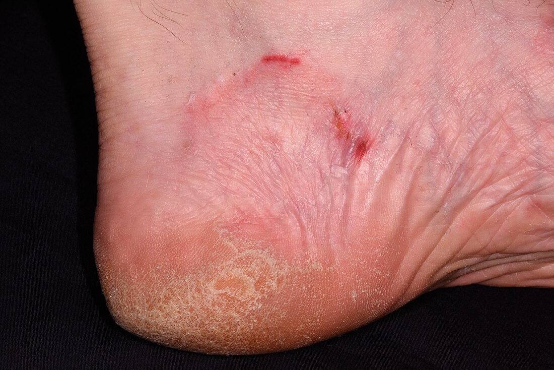 Ringworm on the foot
