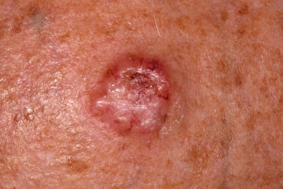 Secondary skin cancer on the forehead