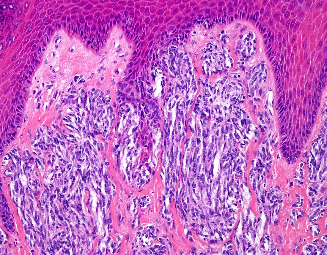 Acral lentiginous melanoma, light micrograph