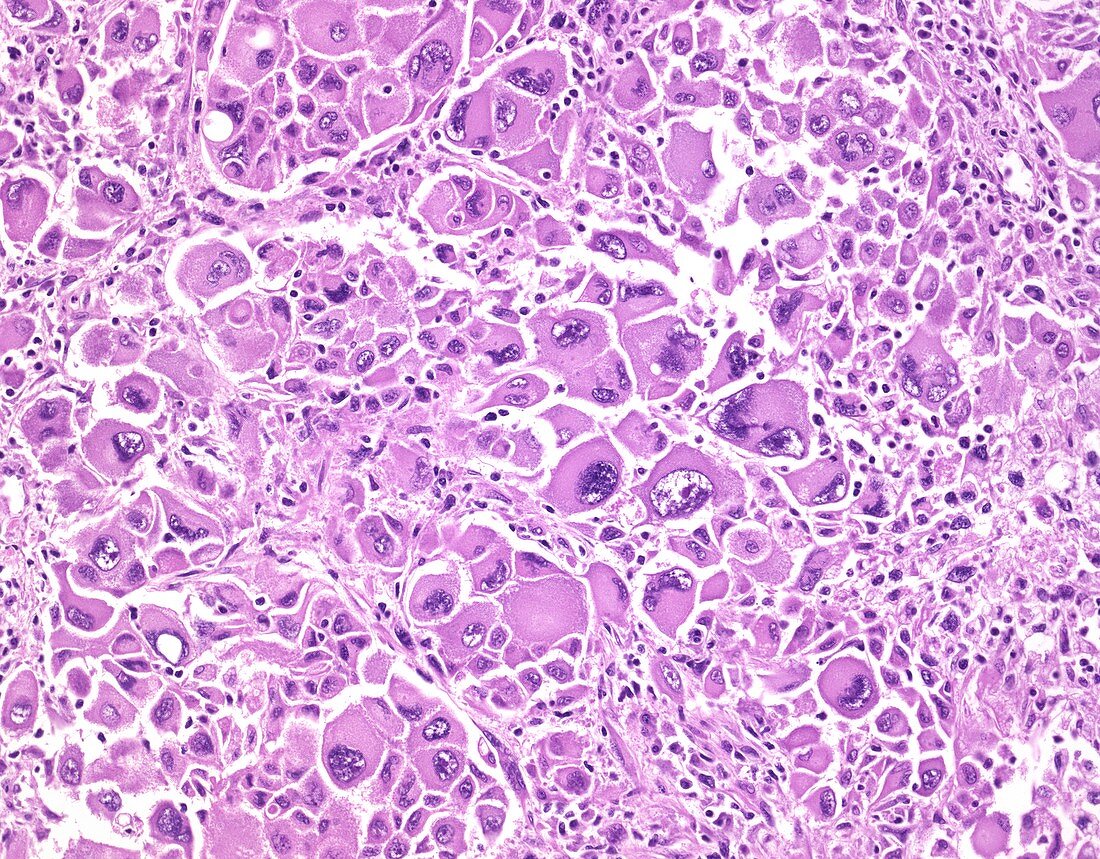 Giant cell melanoma, light micrograph