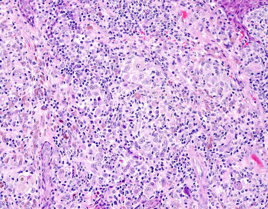 Melanoma tumor infiltrating lymphocytes, light micrograph