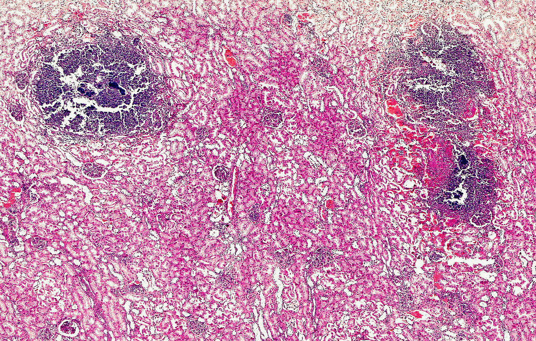 Pyaemic abscesses in kidney tissue, light micrograph
