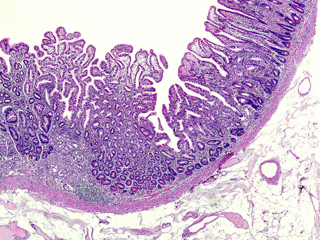 Chronic superficial gastritis, light micrograph
