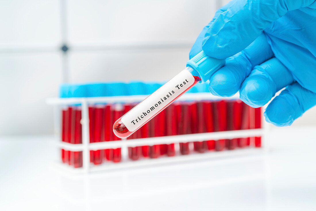 Trichomoniasis blood test, conceptual image