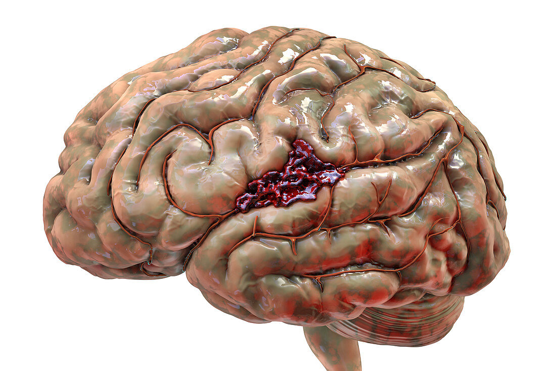 Brain haemorrhage, illustration