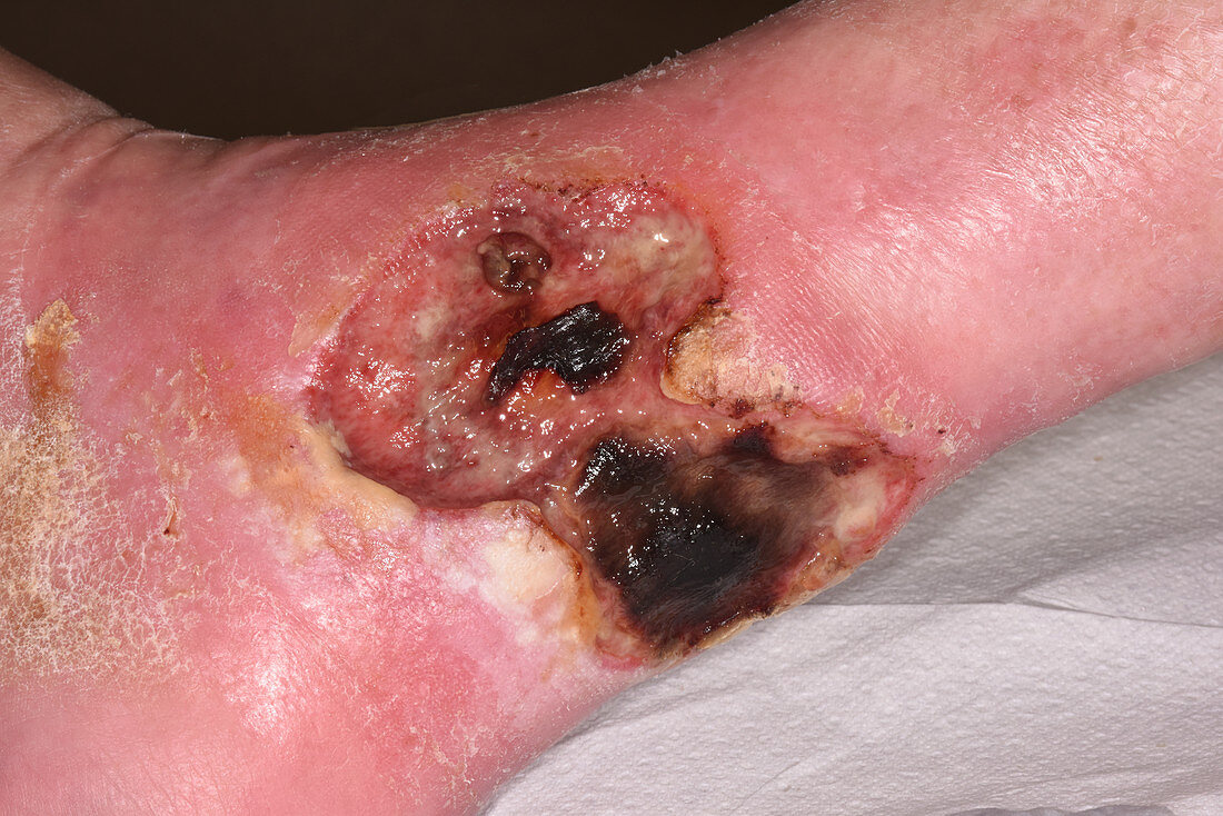 Leg ucler from necrotising vasculitis