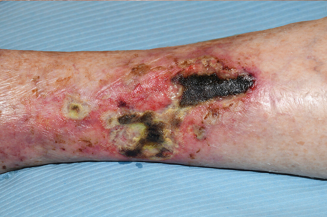 Pyoderma ulcer