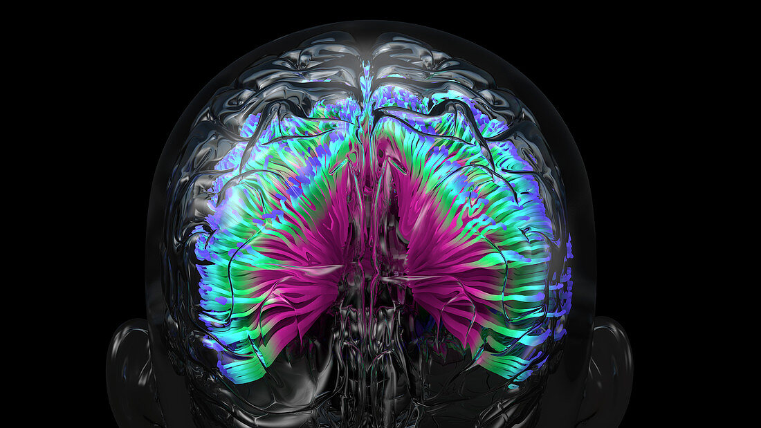 Brain infection, conceptual illustration