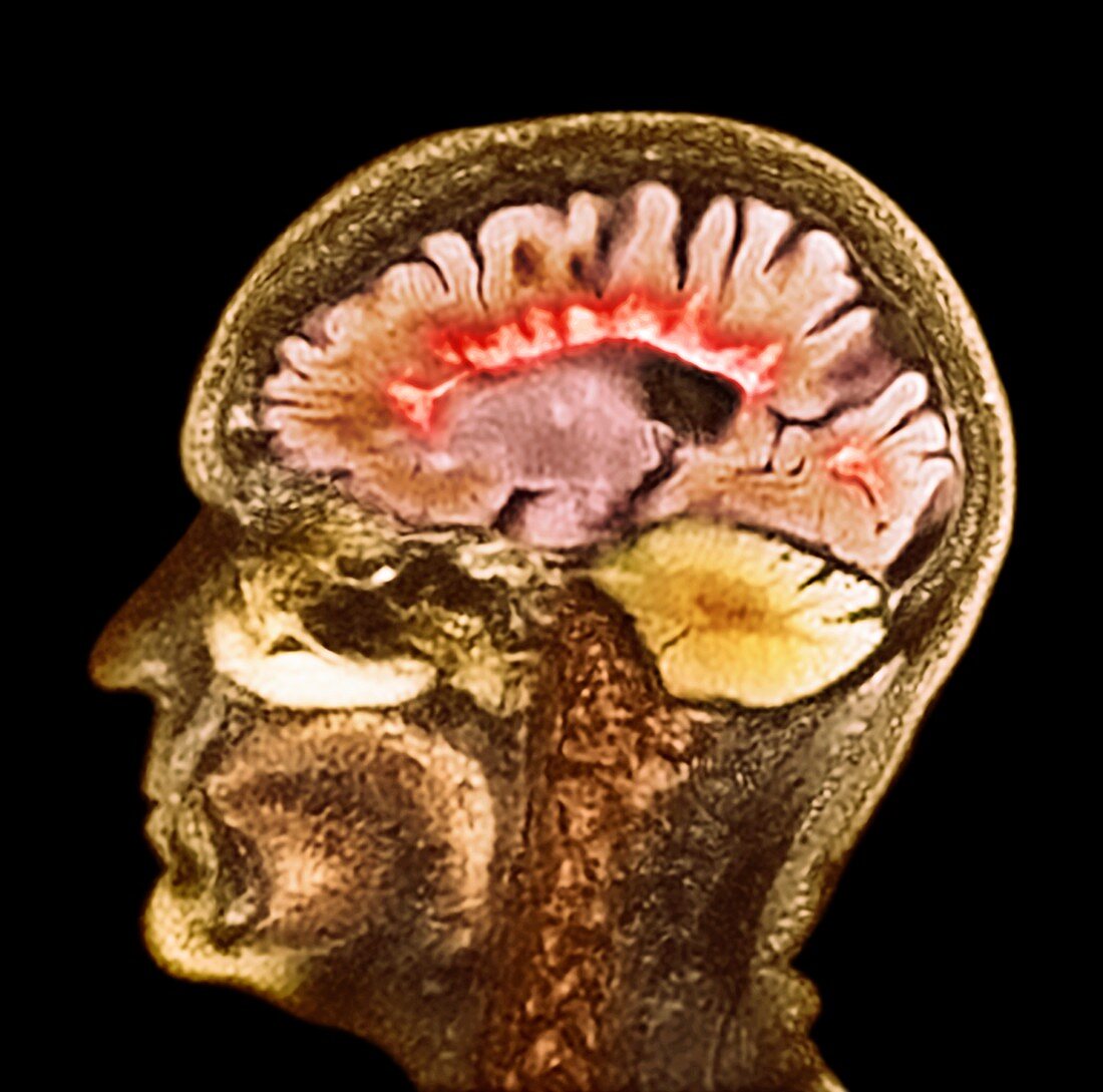Multiple sclerosis, sagittal brain MRI scan