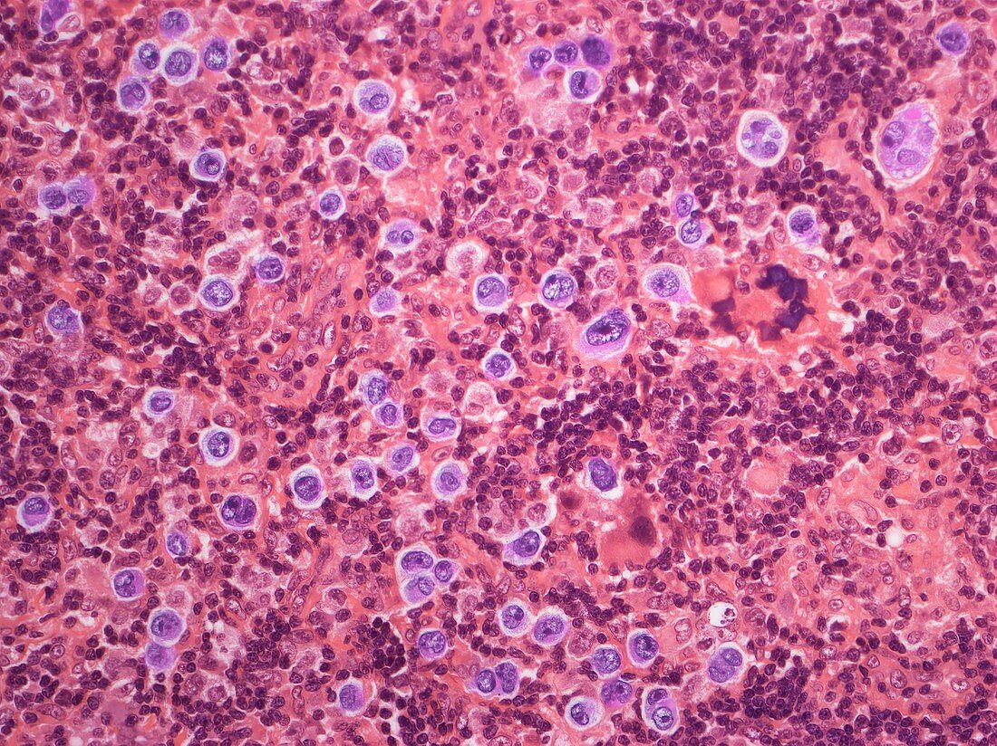 Large B cell lymphoma, LM