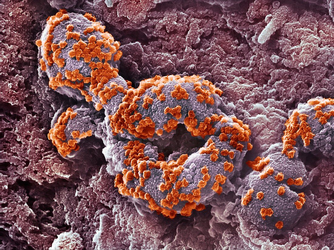 Cell infected by SARS-CoV-2 virus particles, SEM