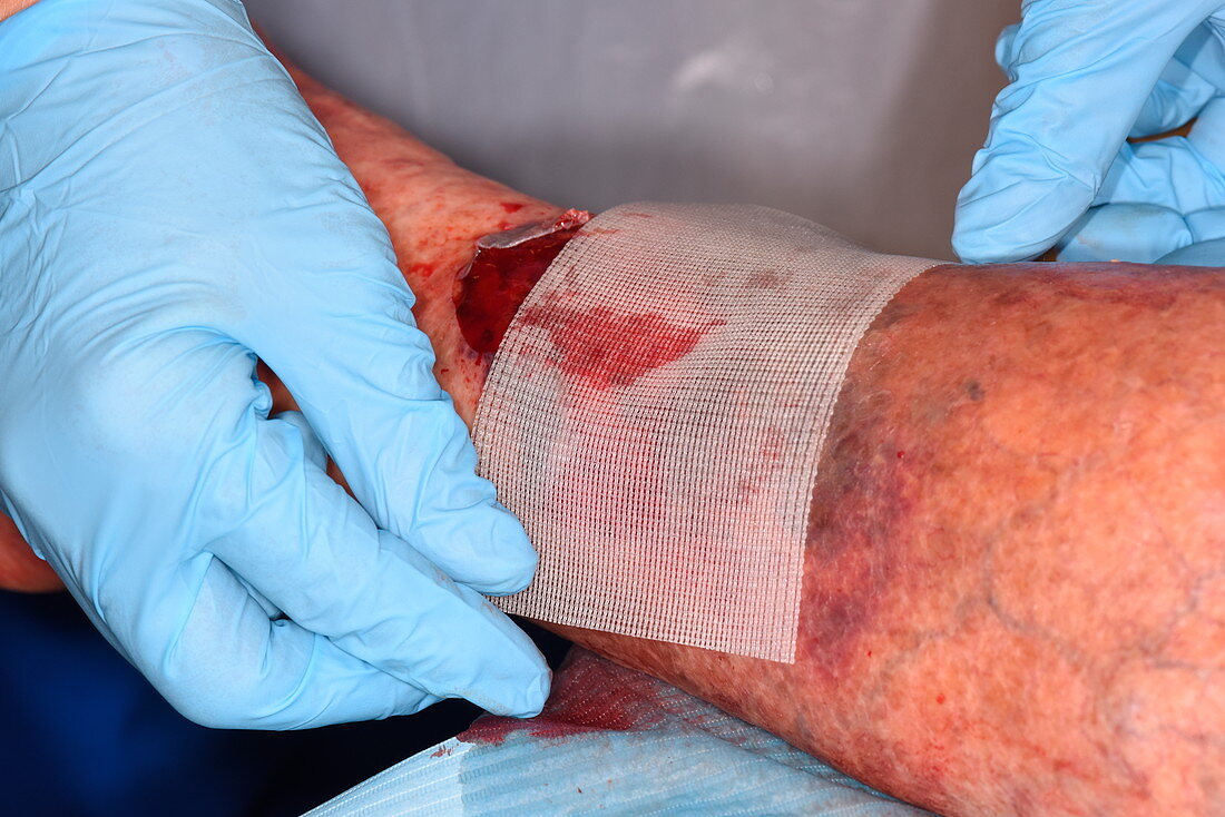 Treating haematoma after an injury