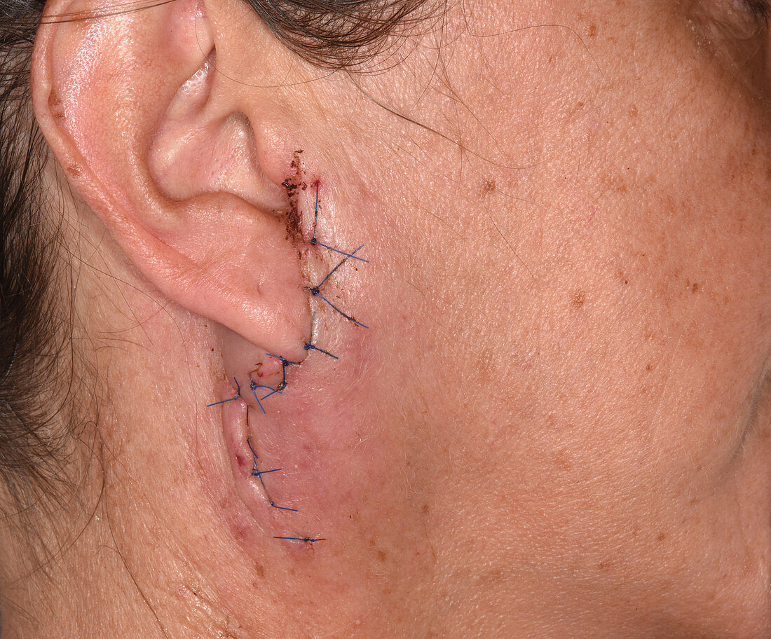 Pleiomorphic adenoma excision wound