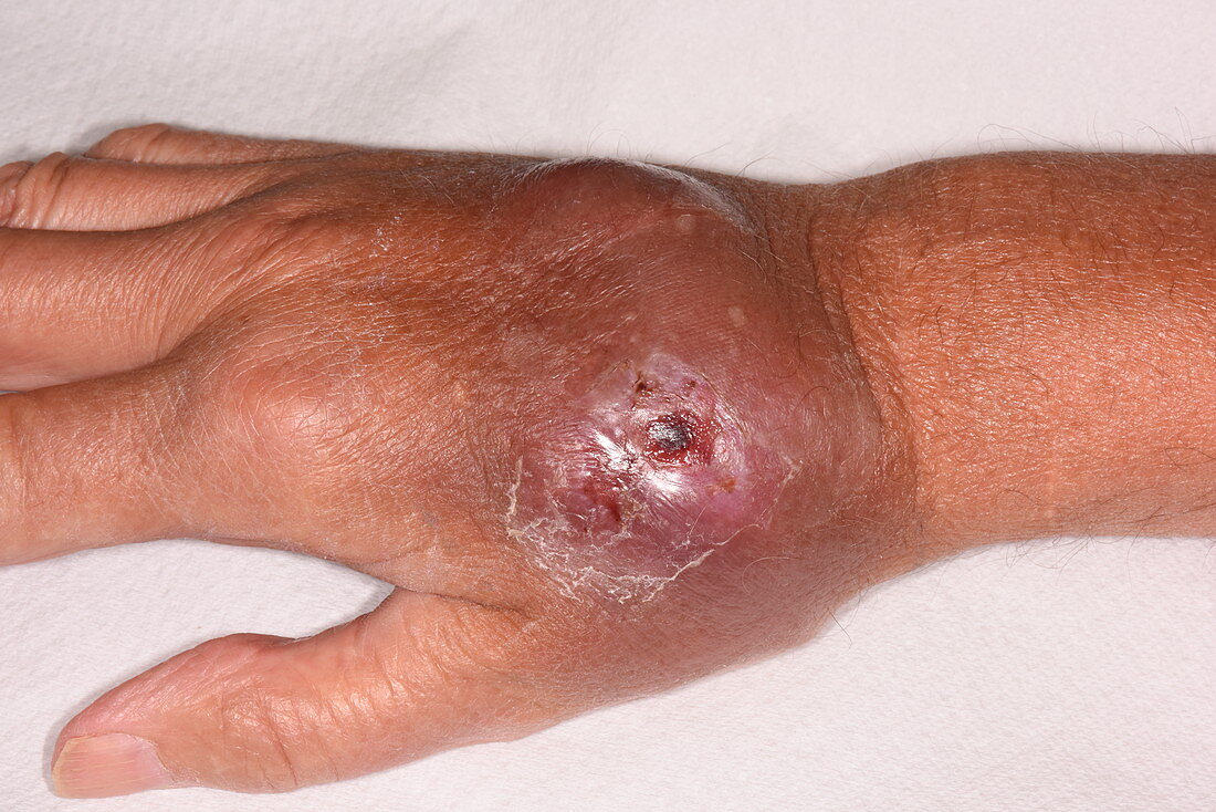 Haematoma on warfarin patient's hand