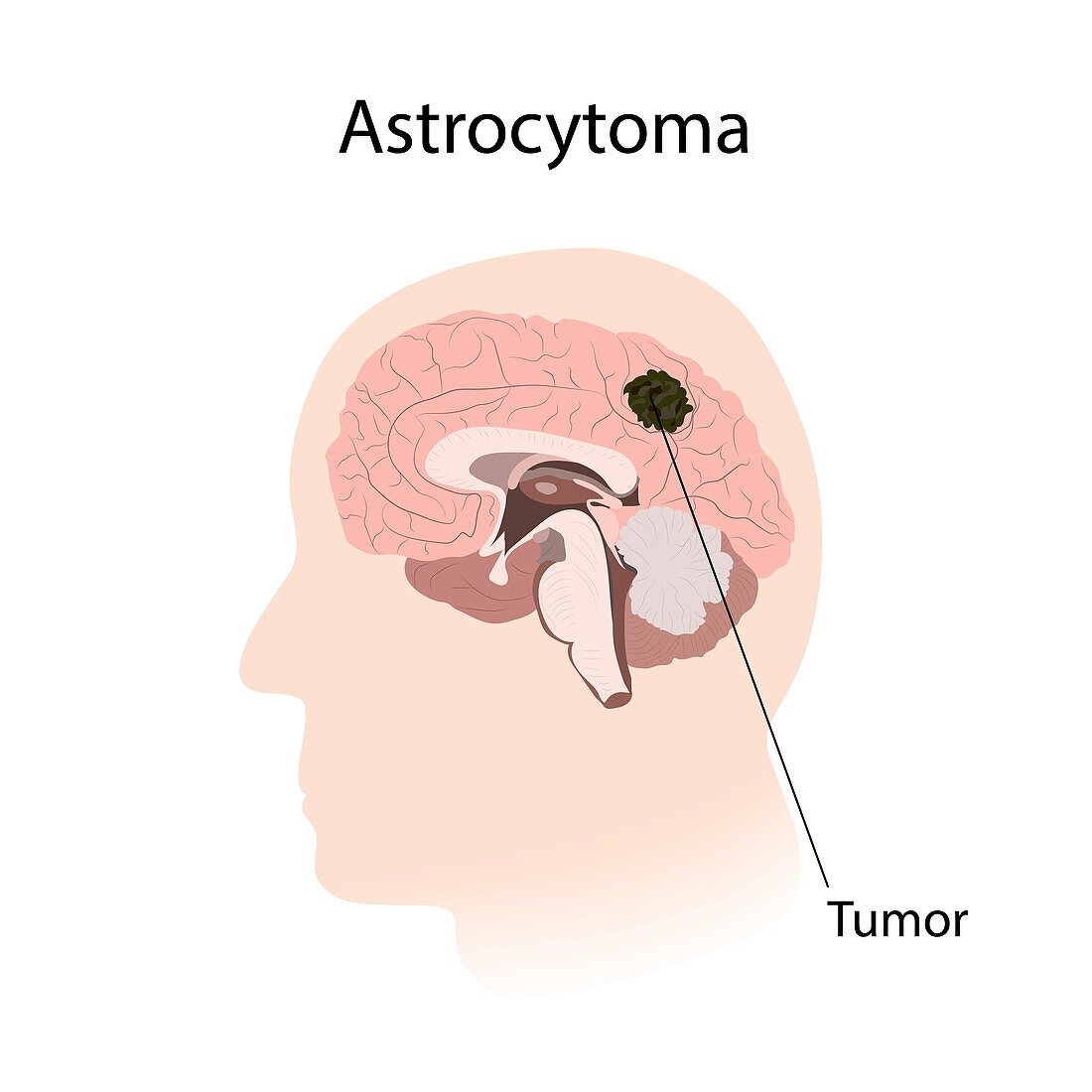 Astrocytoma, illustration