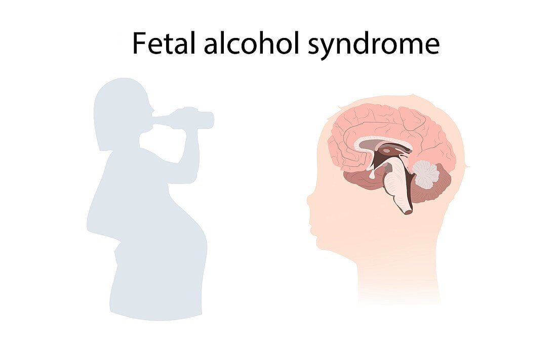 Foetal alcohol syndrome, illustration