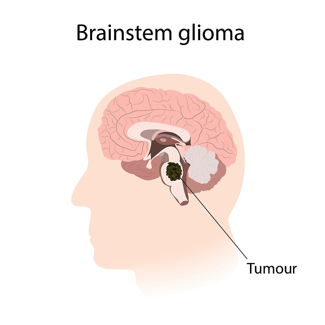 Brainstem glioma, illustration