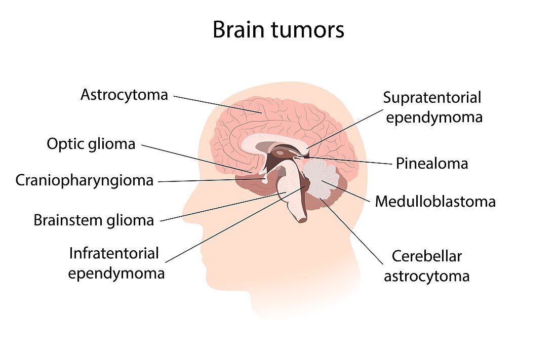Brain tumour with explanations, illustration