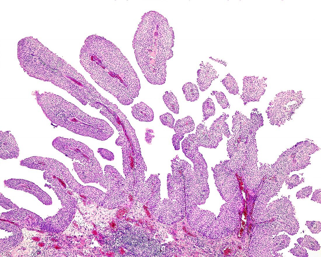 Papillary carcinoma of bladder, light micrograph